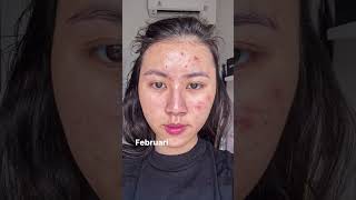 Download lagu Beginilah kalau punya kulit Acne-Prone Skin🙈 mp3