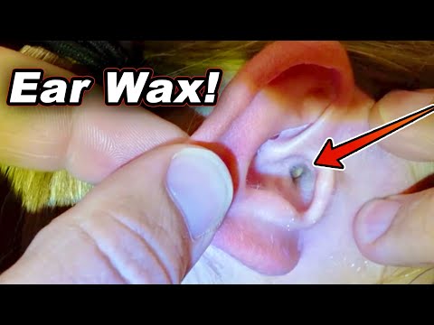 Removing Ear Wax Ball Blocking Ear Drum