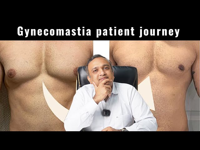 Gynecomastia Patient Journey