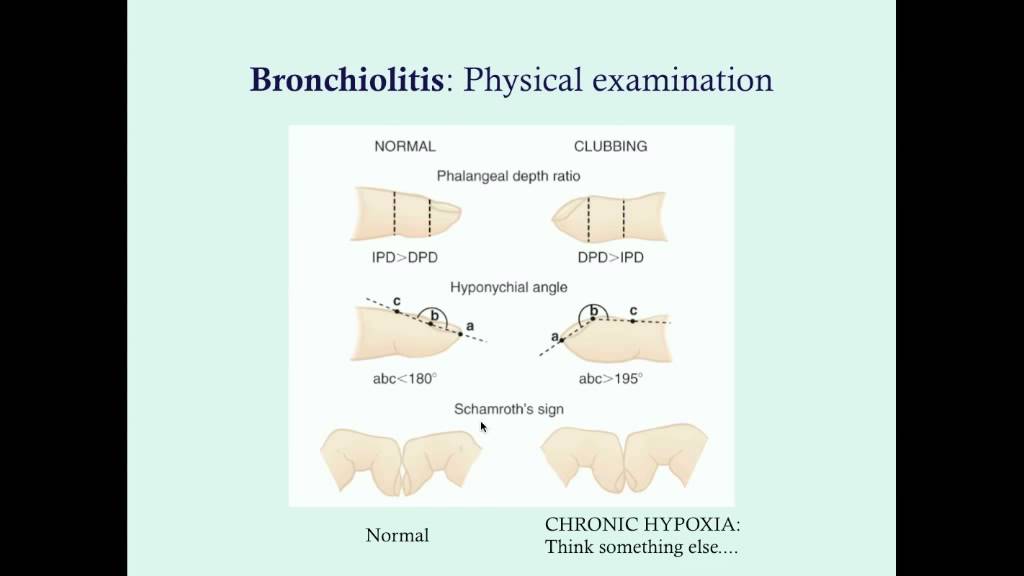 Bronchiolitis - CRASH! Medical Review Series