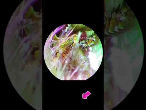 Ear Wax Removal, Hard Cerumen Clean #Shorts