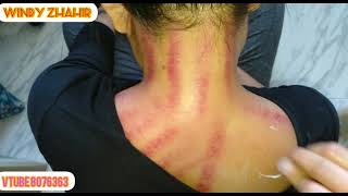 Download lagu Kerokan punggung #kerokan mp3 Download lagu Kerokan punggung #kerokan mp3