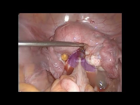 HUGE ENDOMETRIOSIS NODULE INFILTRATING THE RECTUM AND COMPRESSING SACRAL NERVE ROOTS