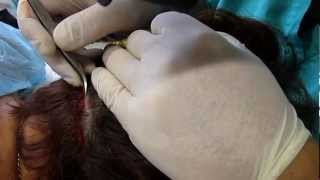 Hair Transplantation for women: FUE Unshaven by Dr. Anastasios Vekris (video)