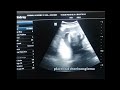 placental chorioangioma|usg