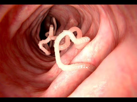 , title : 'Osservate questi sintomi per scoprire i vermi intestinali'