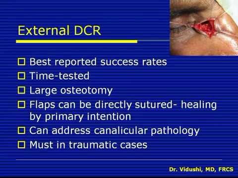 External Dacryo Cysto Rhinostomy, The Procedure
