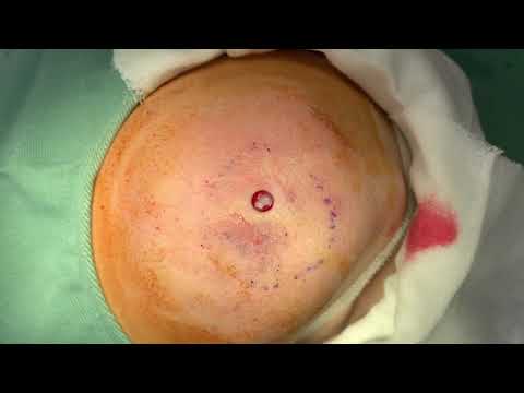 Minimal Excision of Knee Epidermal Cyst Extractions 2026