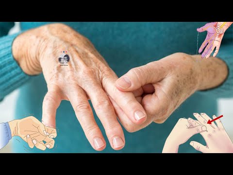 Nese ju dridhen gishtat, duart dhe kembet, keto jane shenja se trupi juaj po vuan nga kjo semundje