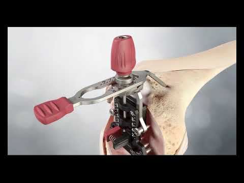 Attune Primary FB -  Surgical Technique Animation