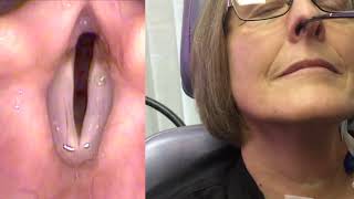 Technique for abductor botulinum toxin injection