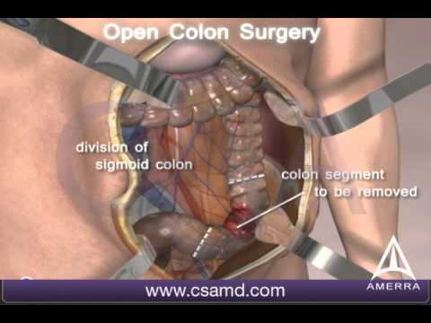 Surgery for Colon Cancer Treatment