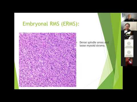"Rhabdomyosarcoma" by Dr M Jula; expert comments by Prof Larry Hadley