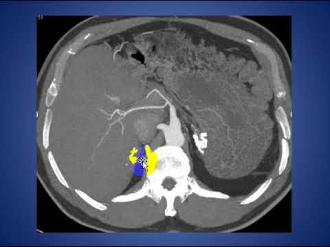 Adrenal Calcification Revisited