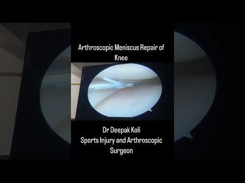 Knee meniscus Repair surgery - Arthroscopy technique- Key hole Surgery| Dr. Deepak Koli