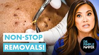 Non-Stop Steatocystoma Removals!  with Dr. Pimple Popper