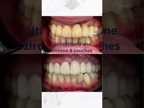 Wecera zircone 8 couches – Restauration