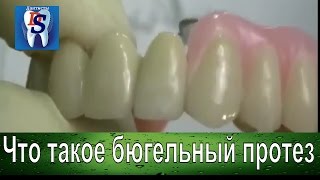 Бюгельный протез Новиники в бюгельном протезировании Ортопедическая стоматология