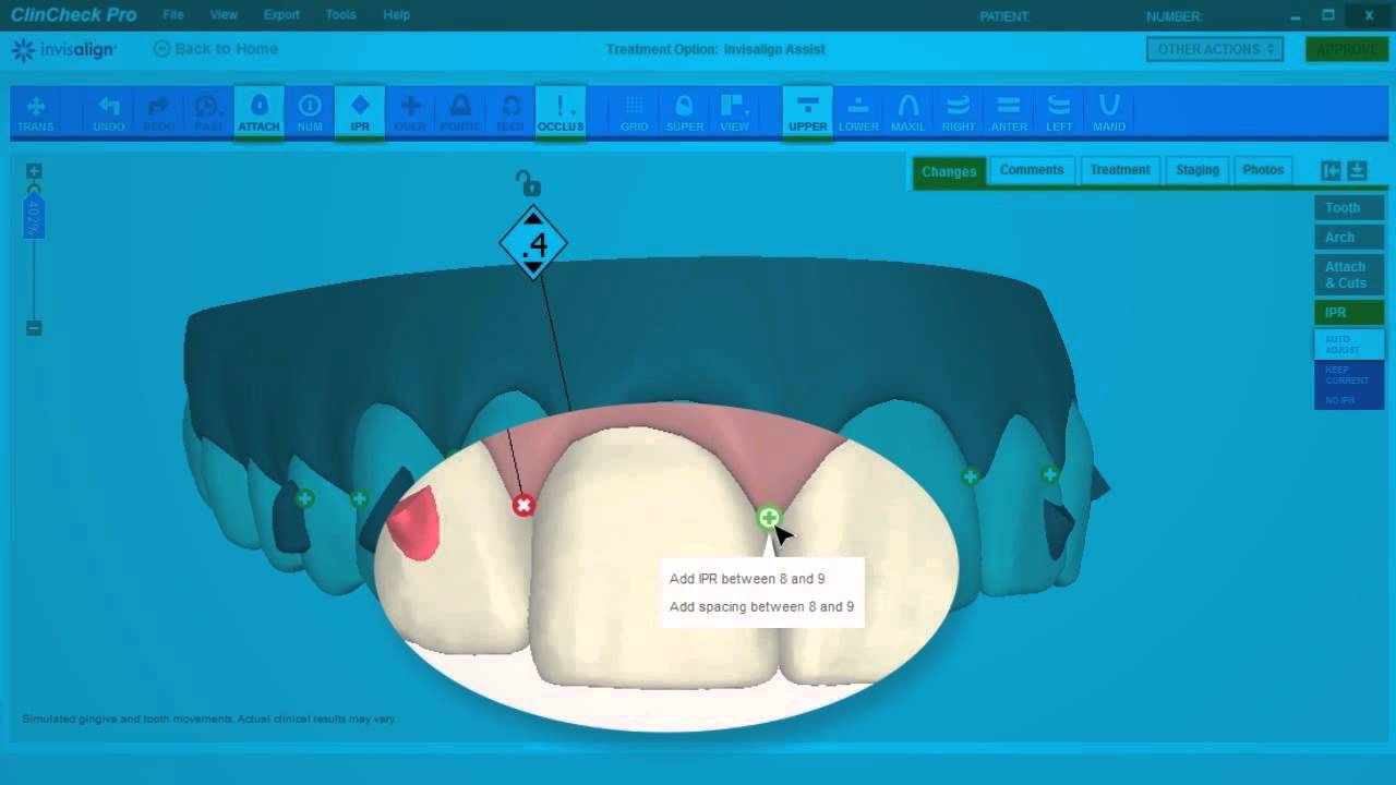 ClinCheck Pro IPR e Espaços - Sistema Invisalign - Blumenau SC