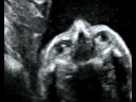 Fetal Medicine Foundation - Microftalmia