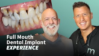 Full Mouth Dental Implant Experience - Follow this actual patient from start to finish!