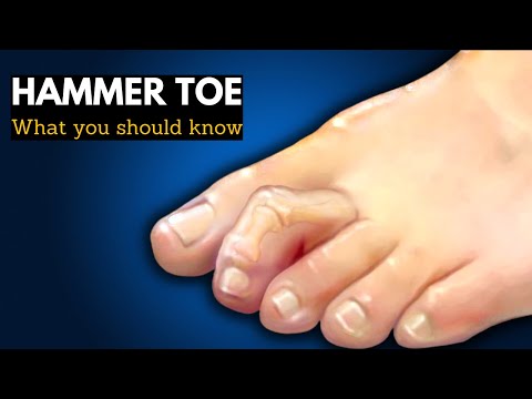 Hammer Toe or Mallet Toe, Causes, Signs and Symptoms, Diagnosis and Treatment.