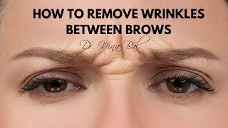 How To Get Rid Of Wrinkles Between Eyebrows 💕 Dr Nina Bal, Glabellar Lines Removal