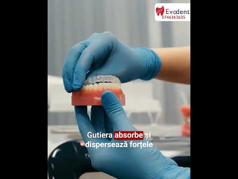 Poate bruxismul afecta implanturile dentare?