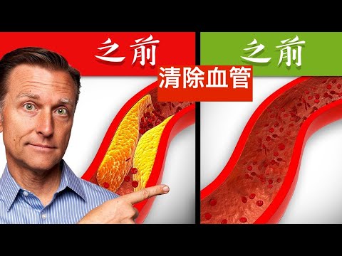 清除血管阻塞、血管內斑塊的最好5種營養素,自然療法,柏格醫生 Dr Berg (清除血管阻塞、血管內斑塊的最好5種營養素,自然療法,柏格醫生 Dr Berg)