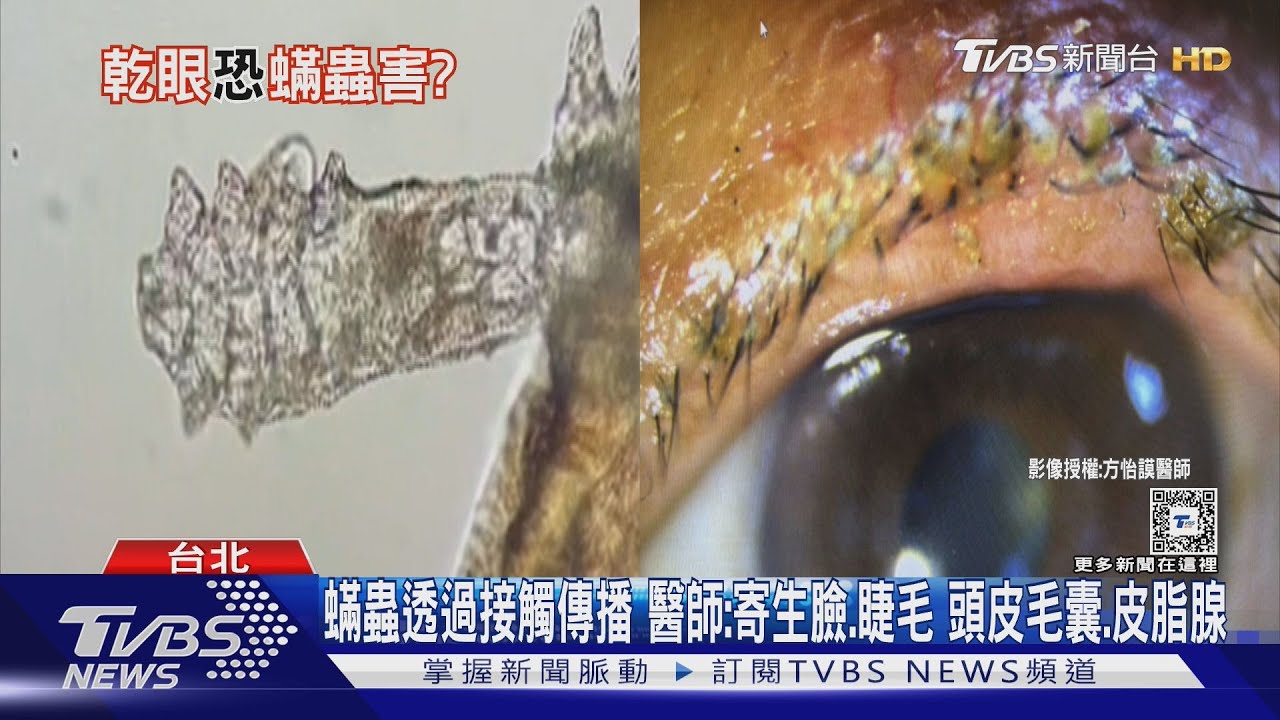 小心！蟎蟲寄生在身體「這部位」引起發炎物質　醫師：出現永久性傷害