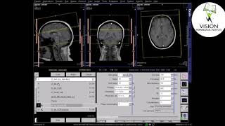 Download lagu MRI Brain With Contrast ( Siemens Technique) mp3