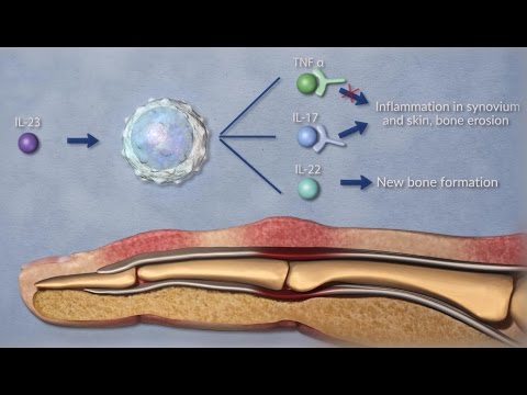 Autoimmune rheumatoid arthritis meaning