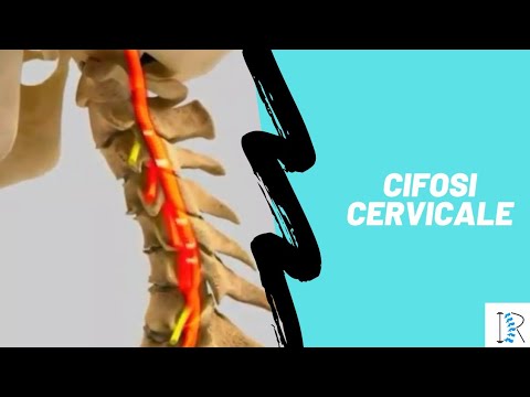 Come trattare lartrosi del ginocchio Dolori articolari durante lesercizio fisico