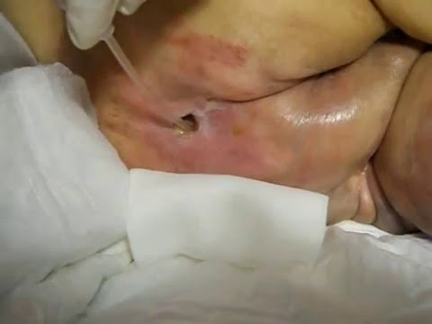 Deformacja i przystanek Koślawe kolana oświadczenie