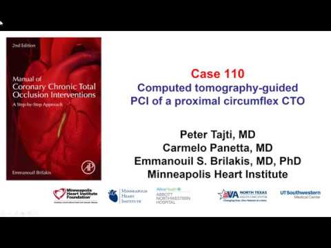 Case 110: Manual of CTO Interventions - CT angiography for guiding ostial circumflex CTO PCI