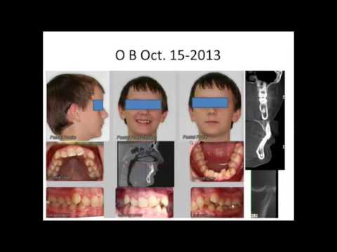 Sphinx Orthodontics - How to Treat Moderate to Severe Crowding