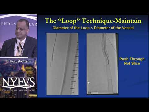 SFA CTO Crossing Techniques Tips and Tricks   B  Purushottam   Endo Fellows Session