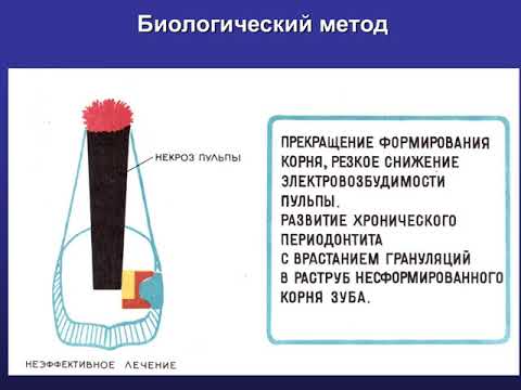 Пульпит постоянных зубов с несформированными корнями