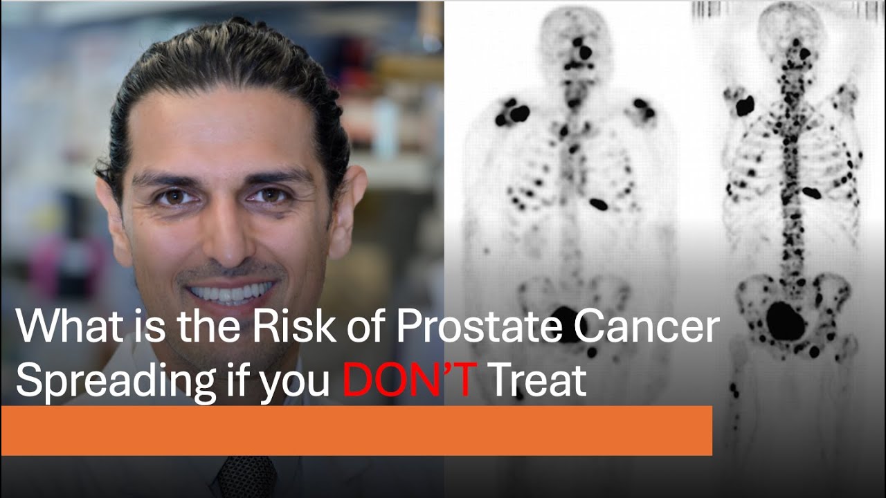 Risk of Metastasis if you DON'T Treat Prostate Cancer
