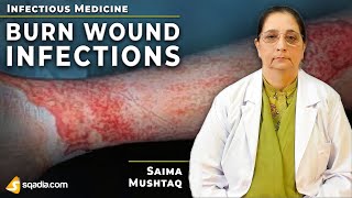 Burn-Wound Infections Diagnosis Internal Medicine Study Guide Lecture V-Learning™