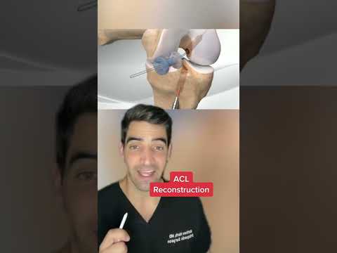 ACL Reconstruction