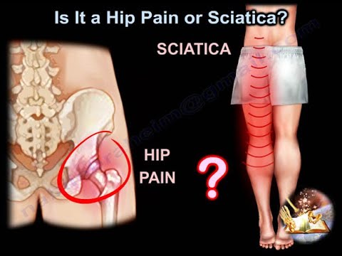 Is It Hip Pain or Sciatica?  which one is causing the pain , how do  I know and how to treat it ?