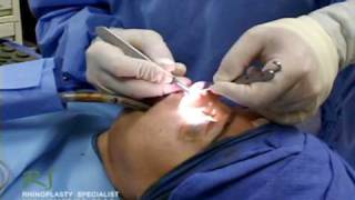 Exposing Nasal Skeleton – Closed Rhinoplasty Procedure Information Video