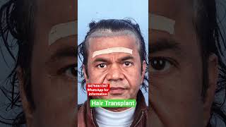 Rajpal Yadav 10 Month Hair Transplant Result video