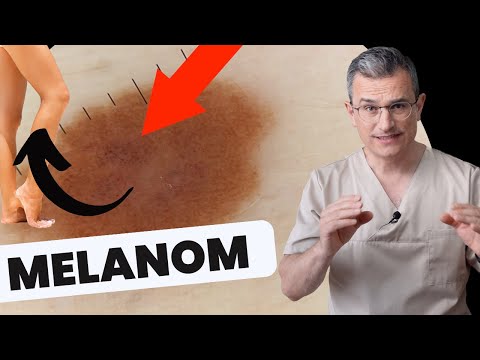 Melanom (schwarzer Hautkrebs) am Unterschenkel: Ein lehrreicher Fall. Dr. Kasten Mainz