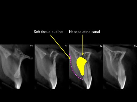 Anatomia radiologiczna kanału nosowo-podniebiennego