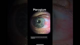 Pterygium, caused by sun damage and can be prevented by good quality sunglasses!