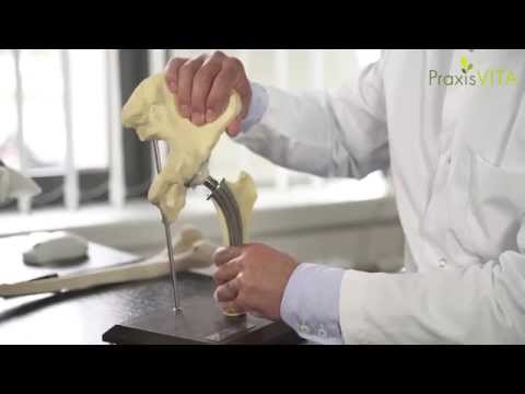 Wie sieht eine künstliche Hüfte aus?