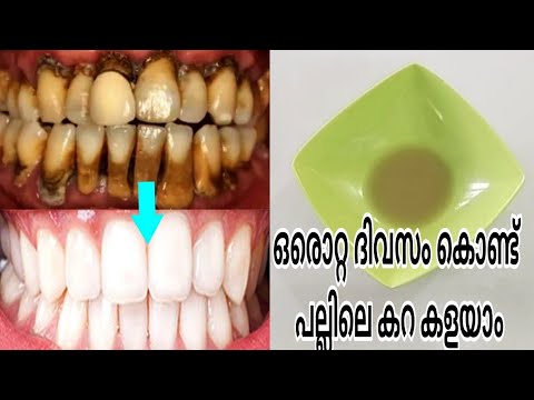 ഒരു ദിവസം കൊണ്ട് പല്ലിലെ കറ കളയാം | Dental Care Malayalam Silu Talks