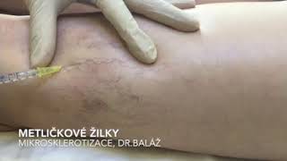 Removal of Varicose veins